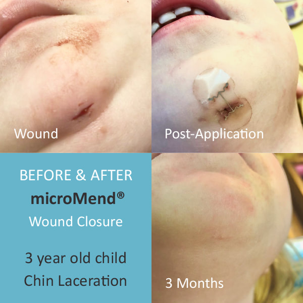 Micromend Skin Closure devi...