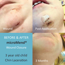 Micromend Skin Closure device | Wound Closure Solutions