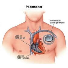 Pacemaker : the battery of heart