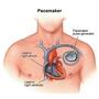 Pacemaker : the battery of heart