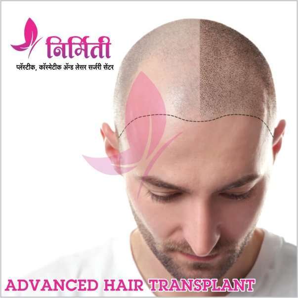 Advanced FUE Hair Transplant