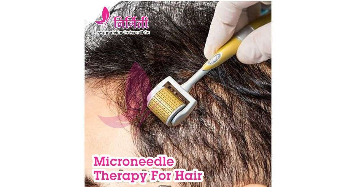 Microneedle Therapy for Hair