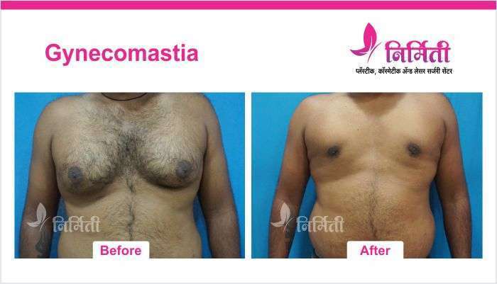 Gynecomastia Surgeon in Kol...
